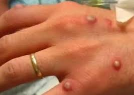 Vaccination against smallpox is assumed to provide protection against human monkeypox infection considering they are closely related viruses. Y5j Ymr18wknrm