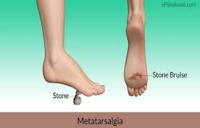 Image result for Metatarsalgia
