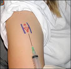 Image result for Biceps Tendon Injection