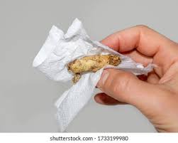 Image result for acholic stools human