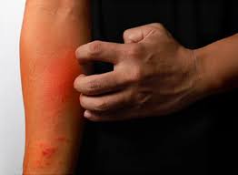 Image result for Atopic Patient