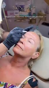 Mapped with intention, treated with precision, Face mapping allows us to  target the muscles responsible for movement — meaning natural, balanced  results, this is how we personalize Anti wrinkle ...