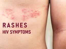 Image result for skin rash acute hiv infection