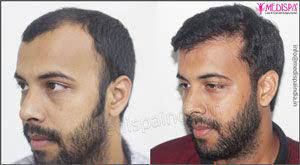 Best hair transplant clinic in kathmandu. Hair Transplant Dubai Cost Medispa Hair Transplant Clinic