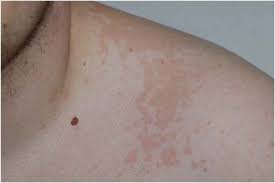Pityriasis versicolor (pv), also known as tinea versicolor, is a common, benign, superficial cutaneous fungal infection usually characterized by hypopigmented or hyperpigmented macules and patches on the chest and the back. Pityriasis Versicolor Springerlink