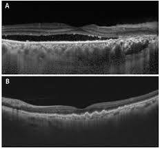 Image result for Choroid