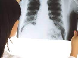 Mal aux cotes en toussant. Cote Felee Suite A Des Quintes De Toux Que Faire