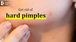 Apply the oil on the pimple and a little around it. How To Get Rid Of Hard Pimples Dr Urmila Nischal Youtube