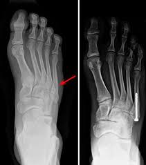 How long does bone healing take? Toe And Forefoot Fractures Orthoinfo Aaos