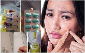 Merawat sifilis diperlukan ubat yang tepat, kerana ubat tidak boleh digunakan untuk menyembuhkan penyakit ini. Lebih 7k Perkongsian Di Social Media Gunakan Dua Bahan Ini Untuk Hilangkan Jerawat Batu Di Muka