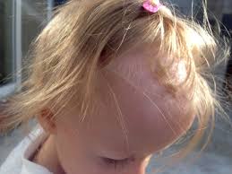 My daughter is three and has always had slight cradle cap. My 1 Year Old Is Losing Her Hair To Cradle Cap All Advice Welcome Steemit