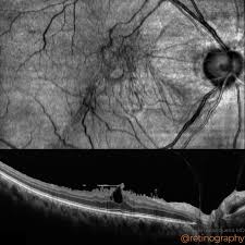 Image result for Eriocoelum