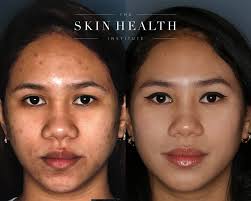 Before achieving the clear 💫 baby soft skin ☁️ she now has, our laser hair  removal expert, @pia.barcimo.shi, battled with unhealthy skin 😨 . To get  to this gorgeous result 😍 Pia