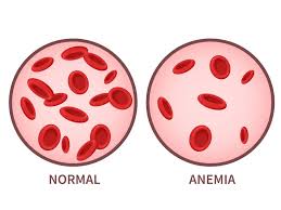 Image result for Anemia angolensis