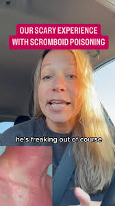 Image result for Scombroid Fish Poisoning