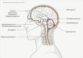 Hirntumoren Symptome Ursachen Diagnose Und Therapie