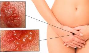 Герпес номер два