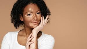 Image result for Vitiligo