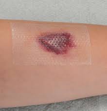 Image result for Skin Tear