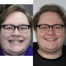 One of my favorite smile makeovers. 😁 I first met Shawn 3 years ago for a  toothache. He quickly became one of my most motivated patients as we worked  together towards comprehensive