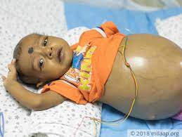 Baby Likith Is In The Last Stages Of Liver Failure And Doesn T Have Much Time Milaap