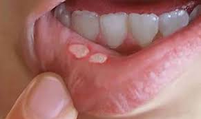 Rostopasca, o planta medicinala foarte importanta. Dureri De Dinti Tratamente Remedii Naturiste Essentialdent Ro