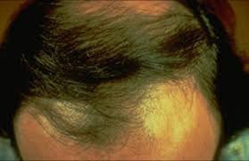 Shedding is often misinterpreted as permanent loss, and it can cause a lot of people to make wild every single summer season i would have a brutal shed and it was literally the life cycle of my hair that's a perfect example of shedding which is temporary loss. Hair Loss Long Island Medical Dermatology Middle Island Surgical Dermatology Stony Brook