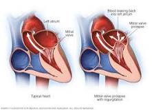 Image result for icd 10 code for mitral prolapse