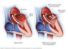 Image result for icd 10 code for mitral prolapse