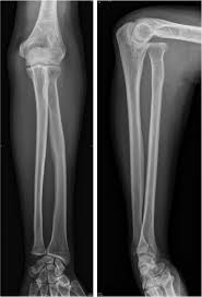 Image result for Radial Head Dislocation