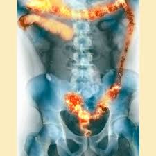Unfortunately, stomach cancer is hard enough to detect in the early stages, because it does not have any specific first signs, only based on which, one could state with confidence the fact that we are talking directly about a malignant tumor. 9 People Describe How They Were Diagnosed With Ulcerative Colitis Self