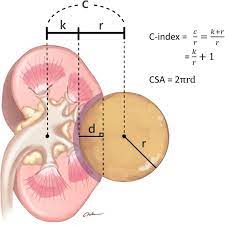 A propensity score matching study based on the seer database. The Role Of Renal Padua C Index Csa Nephrometry Systems In Predicting Ipsilateral Renal Function After Partial Nephrectomy Bmc Urology Full Text