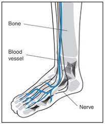 Diabetic neuropathy is a common serious complication of diabetes. Department Of Surgery Diabetic Peripheral Neuropathy