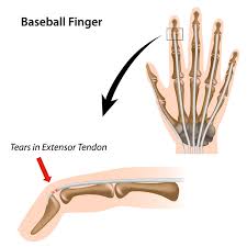 Mallet finger refers to injuries of the extensor mechanism of the finger at the level of the distal interphalangeal joint (dip). Mallet Finger Hand Injury Causes Symptoms Treatments