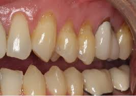 Image result for Tooth Abrasion