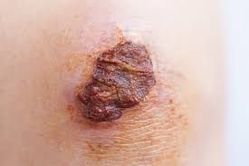 (17) to test if cerium neutralized this erythroid inhibitor, we applied cerium or silver nitrate to the eschar of a mouse model of thermal injury. 144 Best Eschar Images Stock Photos Vectors Adobe Stock