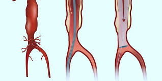 Cuándo preocuparse y consultar a tiempo. Aneurisma De Aorta Sintomas Prevencion Y Tratamiento