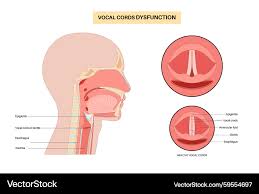 Image result for Vocal Cord Dysfunction