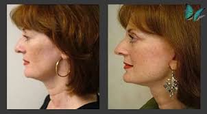 Facelift Beverly Hills