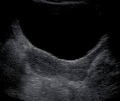 Depending on the patient and the condition being assessed, either one or both of these methods can be used. Normal Uterus Ultrasound How To