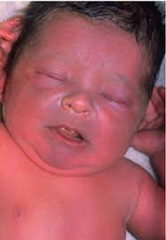 What is postpartum depression, and how can women who experience it get help? The Blue Baby Syndromes American Scientist