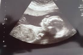 Mid Pregnancy Anomaly Scan What Happens Madeformums
