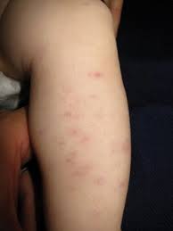 Solar purpura is a condition where long term sun damage to the skin causes easy bleeding into the skin tissue with even slight injury. 4 Month Old With New Onset Petechiae On Bilateral Lower Extremities