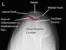 They are attached to the femur (thighbone), tibia (shinbone), and fibula (calf bone) by fibrous tissues called ligaments. Runners Knee New York Dr Nakul Karkare