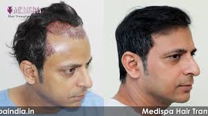 Pin On Celebrity Hair Transplant Result