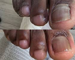 Image result for Beau lines feet