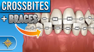 A palate expander is the simplest and most affordable option, landing between $2,000 and $3,000. How Do Braces Fix Crossbites Youtube