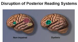 While everyone learns to read and write at different rates, children with dyslexia usually have a harder time sounding out words and sight reading than their peers. Dyslexia And The Brain