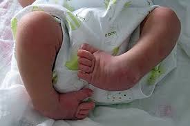 Kecacatan bayi sebenarnya boleh dikesan ketika tiga bulan pertama kehamilan anda. Mmgazette On Twitter Congenital Clubfoot Kecacatan Kaki Bayi Yang Boleh Diperbetulkan Dr Ahmad Mahyuddin Https T Co Vn2lfuz1zw