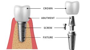 Teeth Whitening